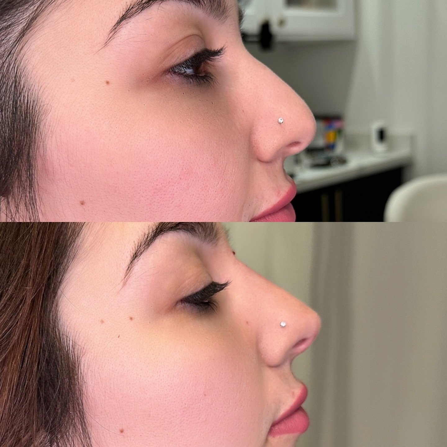 New Nose 👃 🎁
Add beauty has gifted hundreds new nose to our clients 
Come visit the king for new nose this October!
.
.
.
#nosefiller #nonsurgicalfacelift #nonsurgicalnosejob
