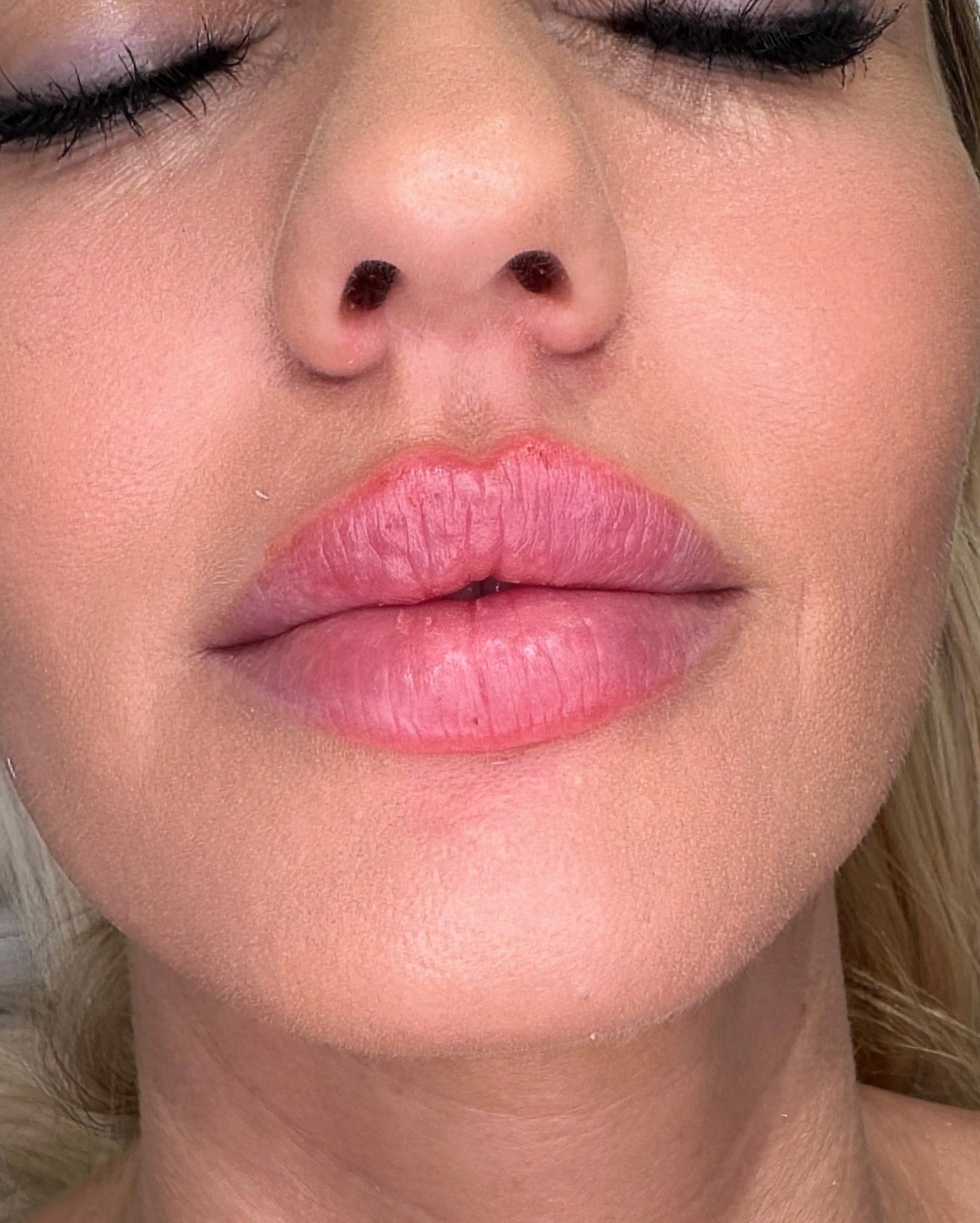 Lip Filler check 🫦
.
.
.
.
#lipfiller #lipfillerbeforeandafter #lips #lipking #bestlipfillers